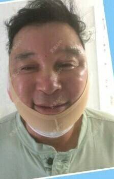 更美 - 大叔的梦想的自体脂肪全面部填充经验 | 自体脂肪全面部填充 | 下面部吸脂 | 祛眼袋手术