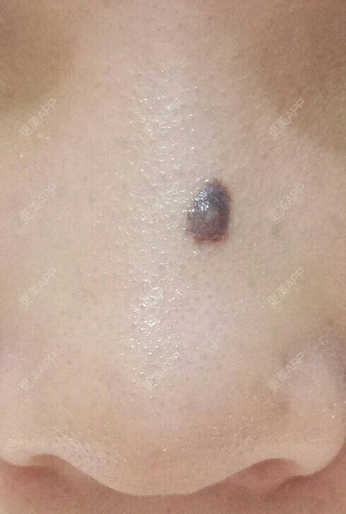 会不会稍嫌呆萌的激光点痣日记