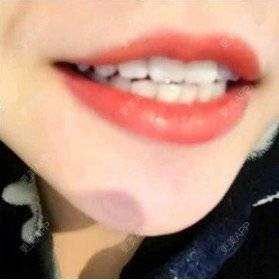 更美 - 黄金闪电的冷光美白经验 | 广州 | 冷光美白