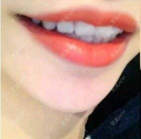 更美 - 黄金闪电的冷光美白经验 | 广州 | 冷光美白