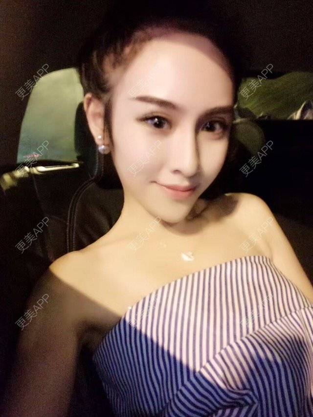 更美 - 青柠乖乖的除皱瘦脸经验 | 注射美容 | 视频日记 | 注射瘦脸针 | 除皱瘦脸 | 青岛