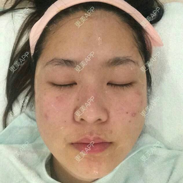 更美 - 更美用户y0YPOy9m23的水光项目经验 | 淡化痘印 | 皮肤水嫩 | 水光项目 | 青岛