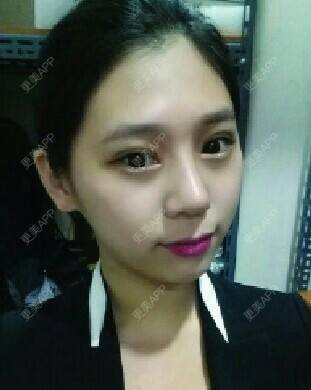 更美 - 陈磊 医生的膨体隆鼻经验 | 膨体隆鼻 | 深圳