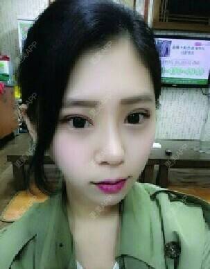 更美 - 陈磊 医生的膨体隆鼻经验 | 膨体隆鼻 | 深圳