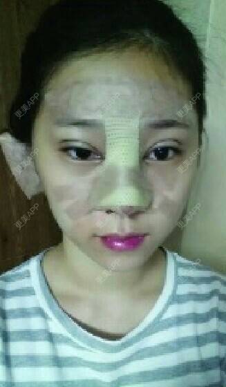 更美 - 陈磊 医生的膨体隆鼻经验 | 膨体隆鼻 | 深圳