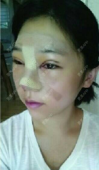 更美 - 陈磊 医生的膨体隆鼻经验 | 膨体隆鼻 | 深圳