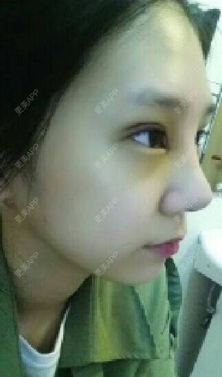 更美 - 陈磊 医生的膨体隆鼻经验 | 膨体隆鼻 | 深圳