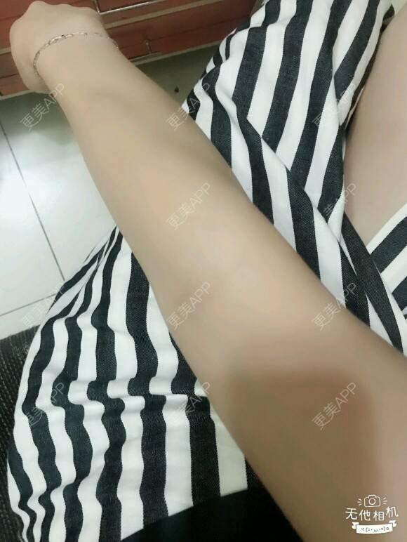 更美 - 网络主播欧美妹子的手臂脱毛经验 | 广州 | 脱毛 | 手臂脱毛 | 冰点激光脱毛
