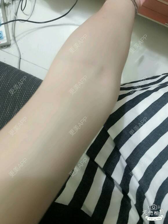 更美 - 网络主播欧美妹子的手臂脱毛经验 | 广州 | 脱毛 | 手臂脱毛 | 冰点激光脱毛