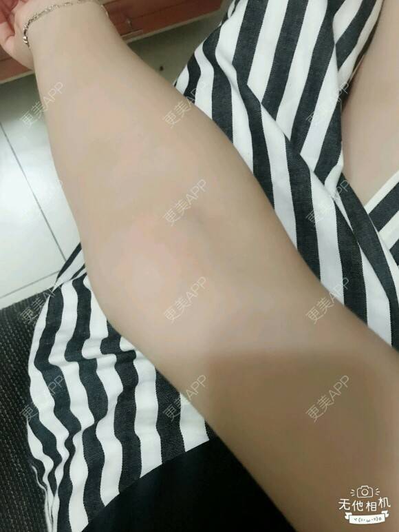 更美 - 网络主播欧美妹子的手臂脱毛经验 | 广州 | 脱毛 | 手臂脱毛 | 冰点激光脱毛