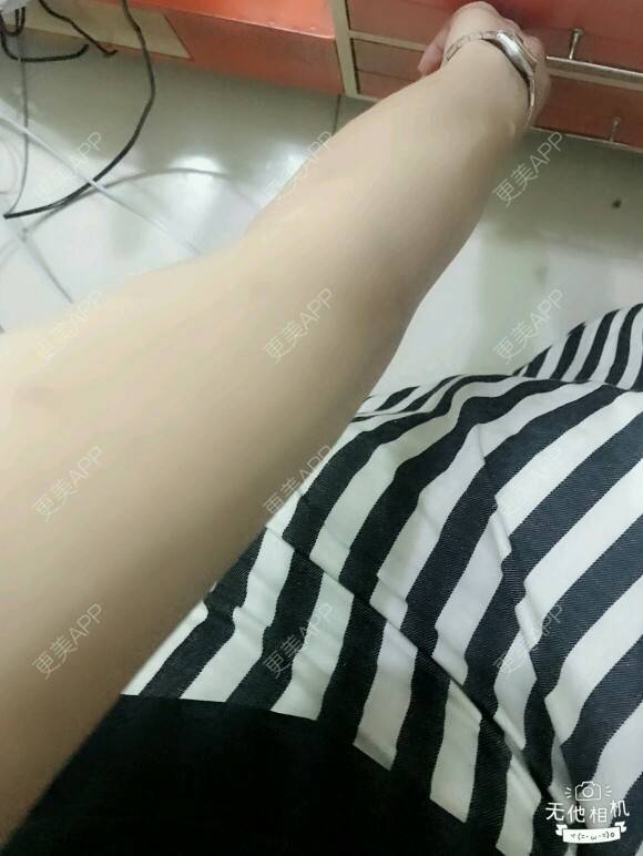 更美 - 网络主播欧美妹子的手臂脱毛经验 | 广州 | 脱毛 | 手臂脱毛 | 冰点激光脱毛