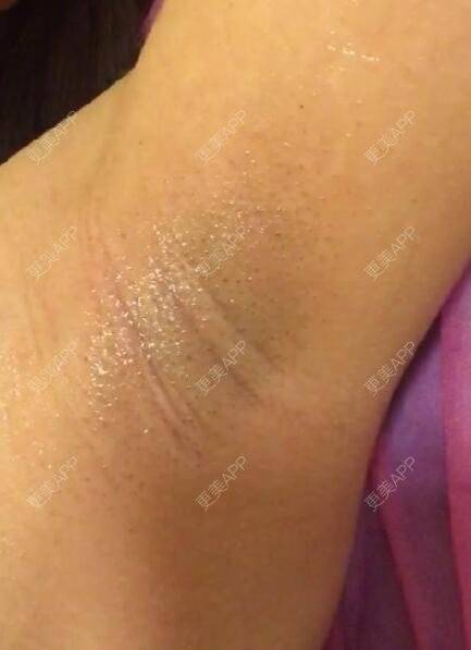 张大伟医生的激光脱毛日记