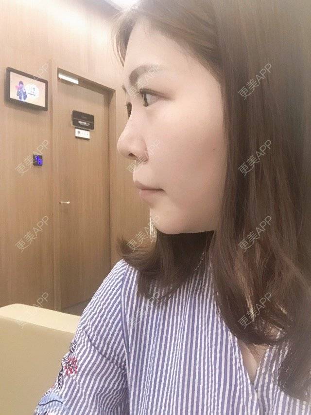 更美 - 更美用户k15N7nue75的玻尿酸经验 | 除皱瘦脸 | 激光淡化红血丝 | 吸脂 | 玻尿酸 | 上海