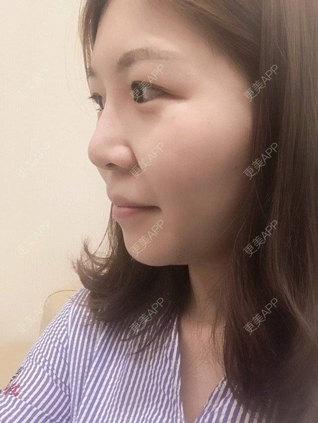 更美 - 更美用户k15N7nue75的玻尿酸经验 | 除皱瘦脸 | 激光淡化红血丝 | 吸脂 | 玻尿酸 | 上海