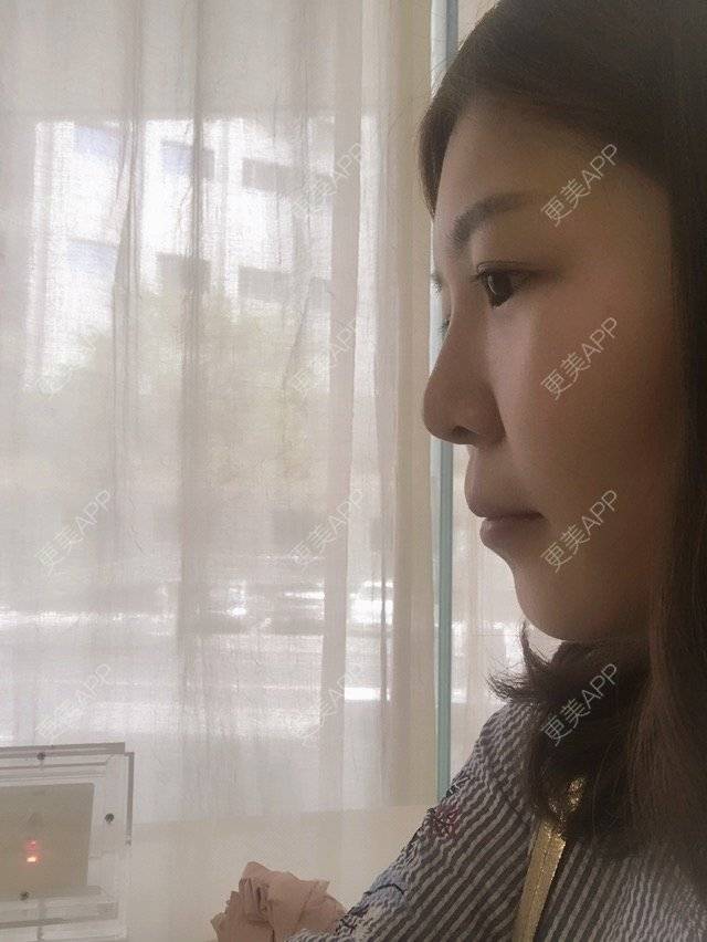 更美 - 更美用户k15N7nue75的玻尿酸经验 | 除皱瘦脸 | 激光淡化红血丝 | 吸脂 | 玻尿酸 | 上海