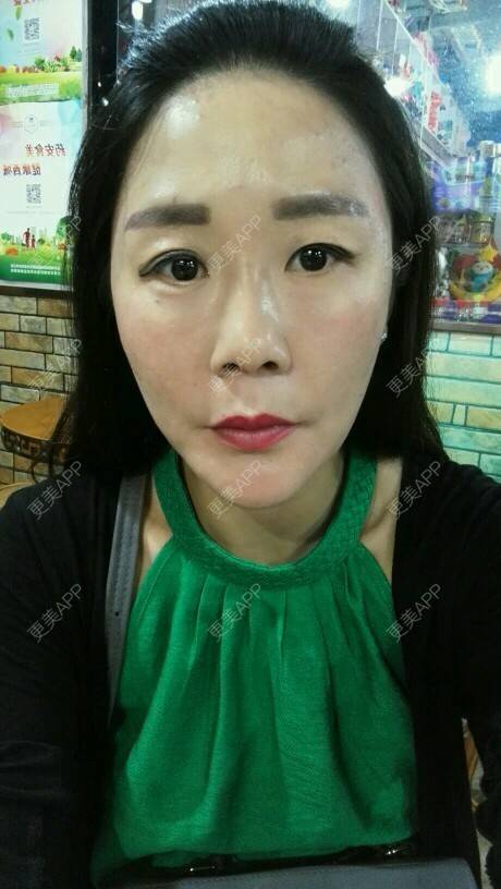 更美 - 柠檬茶来一杯的皮秒激光经验 | 北京 | 皮秒激光