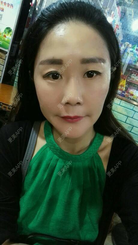 更美 - 柠檬茶来一杯的皮秒激光经验 | 北京 | 皮秒激光