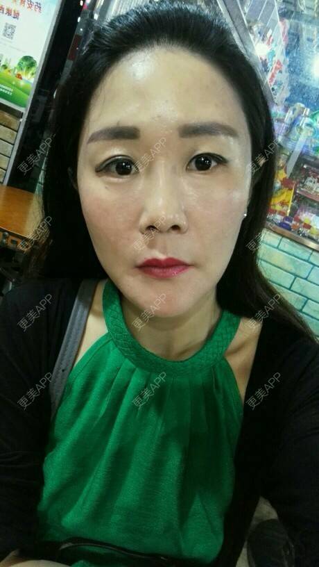 更美 - 柠檬茶来一杯的皮秒激光经验 | 北京 | 皮秒激光