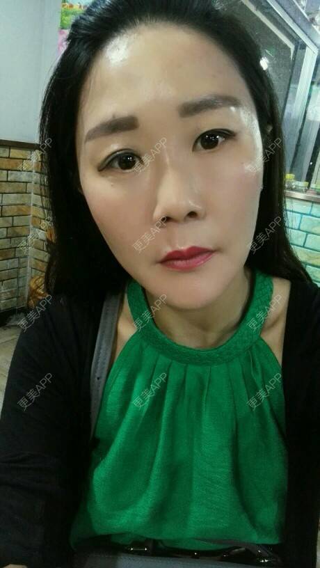 更美 - 柠檬茶来一杯的皮秒激光经验 | 北京 | 皮秒激光