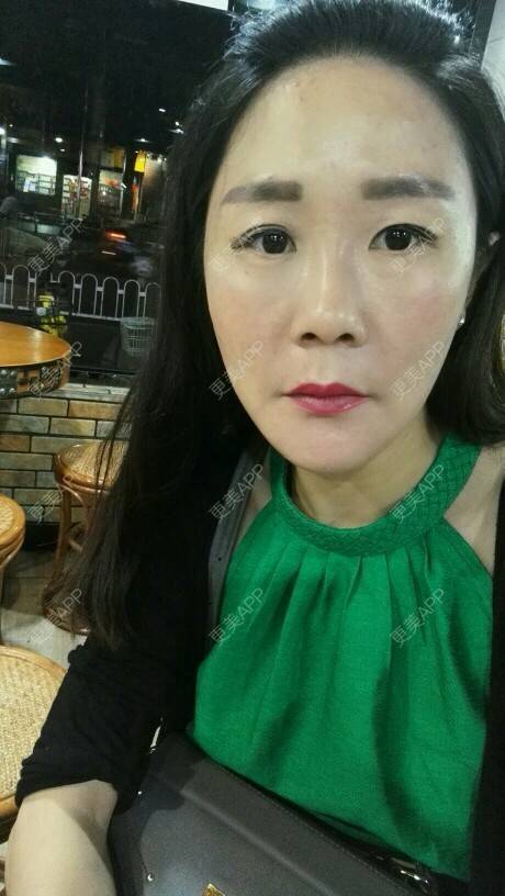 更美 - 柠檬茶来一杯的皮秒激光经验 | 北京 | 皮秒激光