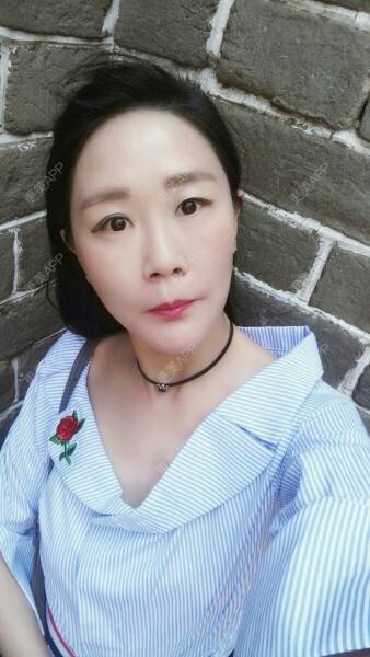 更美 - 柠檬茶来一杯的皮秒激光经验 | 北京 | 皮秒激光