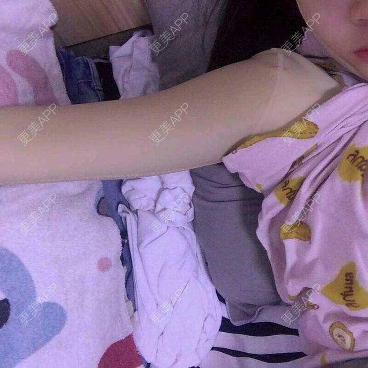 更美用户neftyk3h4x的手臂吸脂日记