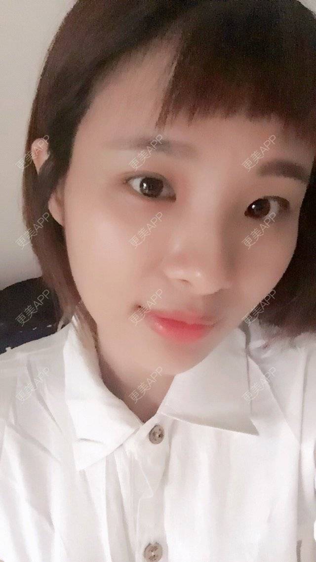 更美 - 照相机、的经验 | 注射美容 | 自体脂肪全面部填充 | 重庆 | 视频日记 | 吸脂手术
