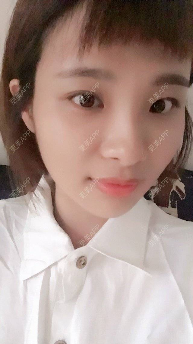 更美 - 照相机、的经验 | 注射美容 | 自体脂肪全面部填充 | 重庆 | 视频日记 | 吸脂手术