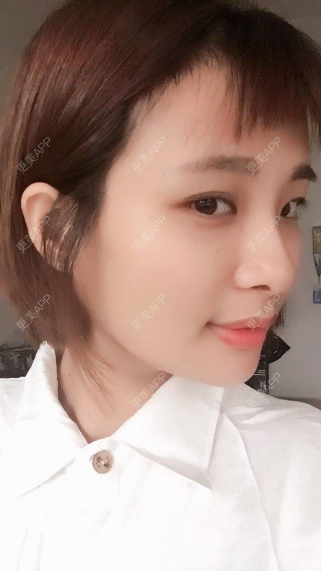 更美 - 照相机、的经验 | 注射美容 | 自体脂肪全面部填充 | 重庆 | 视频日记 | 吸脂手术
