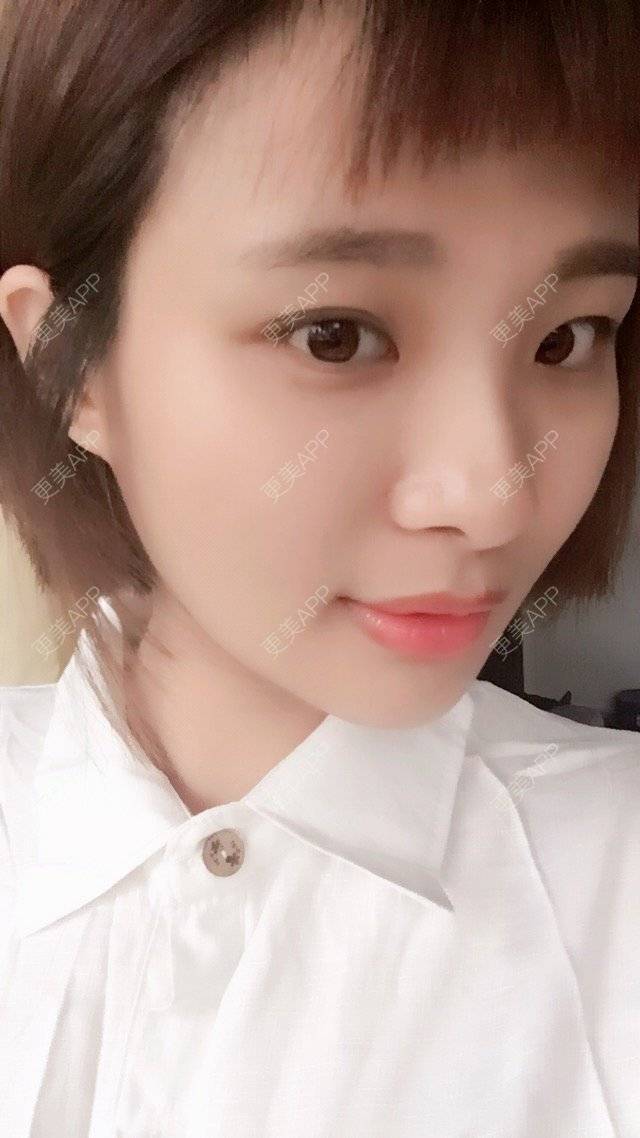 更美 - 照相机、的经验 | 注射美容 | 自体脂肪全面部填充 | 重庆 | 视频日记 | 吸脂手术