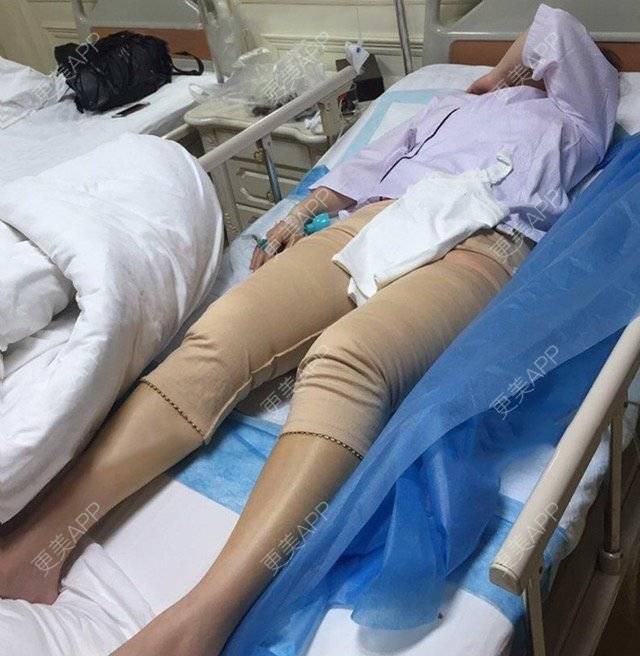 更美 - 吕婧 医生的吸脂经验 | 术后求抱抱 | 吸脂 | 吸脂瘦大腿 | 成都