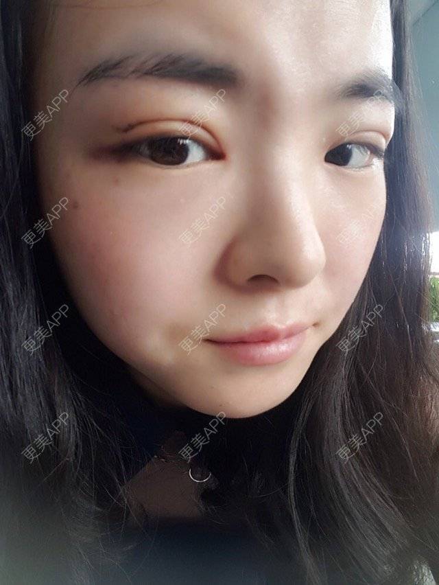 更美 - 爱你521爱他520的双眼皮日记 | 北京 | 内开眼角 | 双眼皮