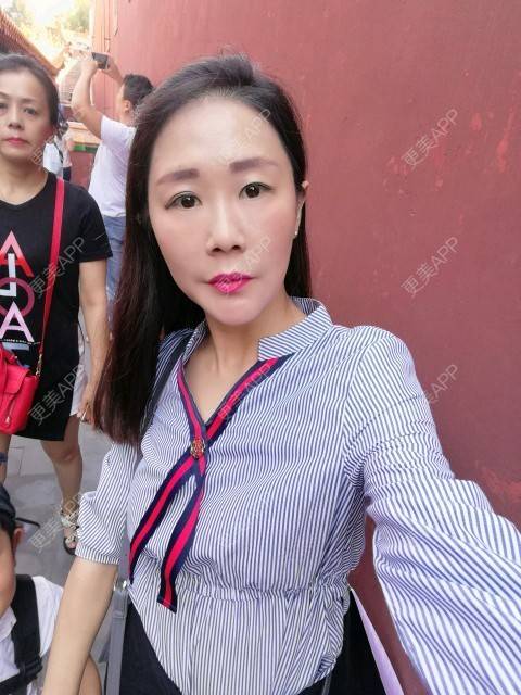 更美 - 柠檬茶来一杯的皮秒激光经验 | 北京 | 皮秒激光