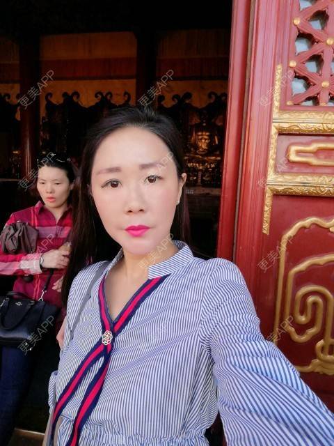 更美 - 柠檬茶来一杯的皮秒激光经验 | 北京 | 皮秒激光