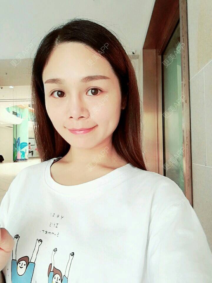 更美 - Jen Tong的经验 | 自体软骨垫鼻尖 | 鼻部整形 | 重庆 | 自体软骨隆鼻