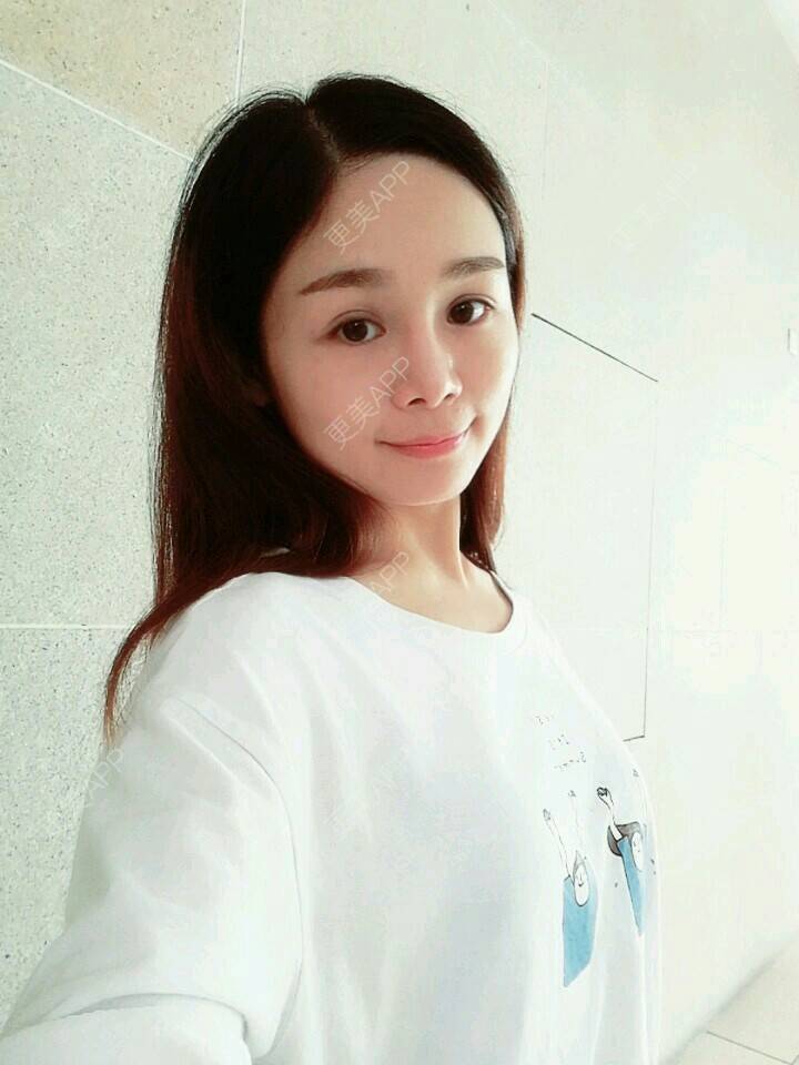 更美 - Jen Tong的经验 | 自体软骨垫鼻尖 | 鼻部整形 | 重庆 | 自体软骨隆鼻
