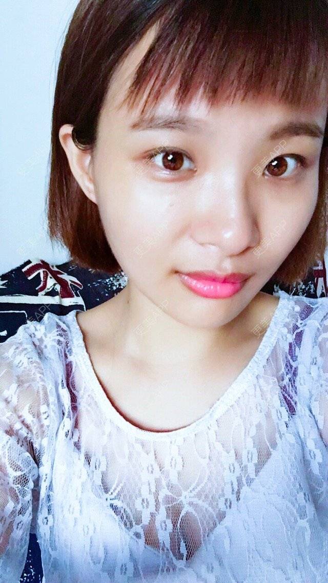 更美 - 照相机、的经验 | 注射美容 | 视频日记 | 重庆 | 自体脂肪丰全面部 | 吸脂手术