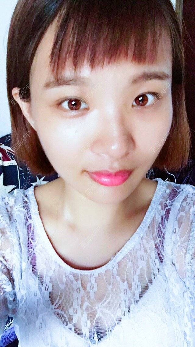 更美 - 照相机、的经验 | 注射美容 | 视频日记 | 重庆 | 自体脂肪丰全面部 | 吸脂手术