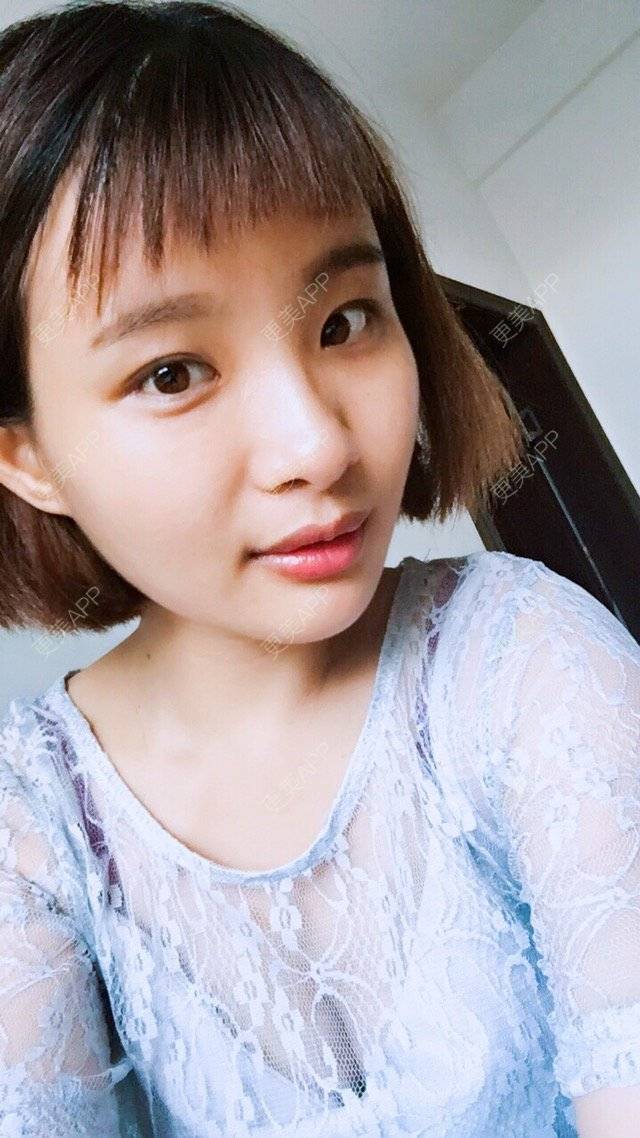 更美 - 照相机、的经验 | 注射美容 | 视频日记 | 重庆 | 自体脂肪丰全面部 | 吸脂手术