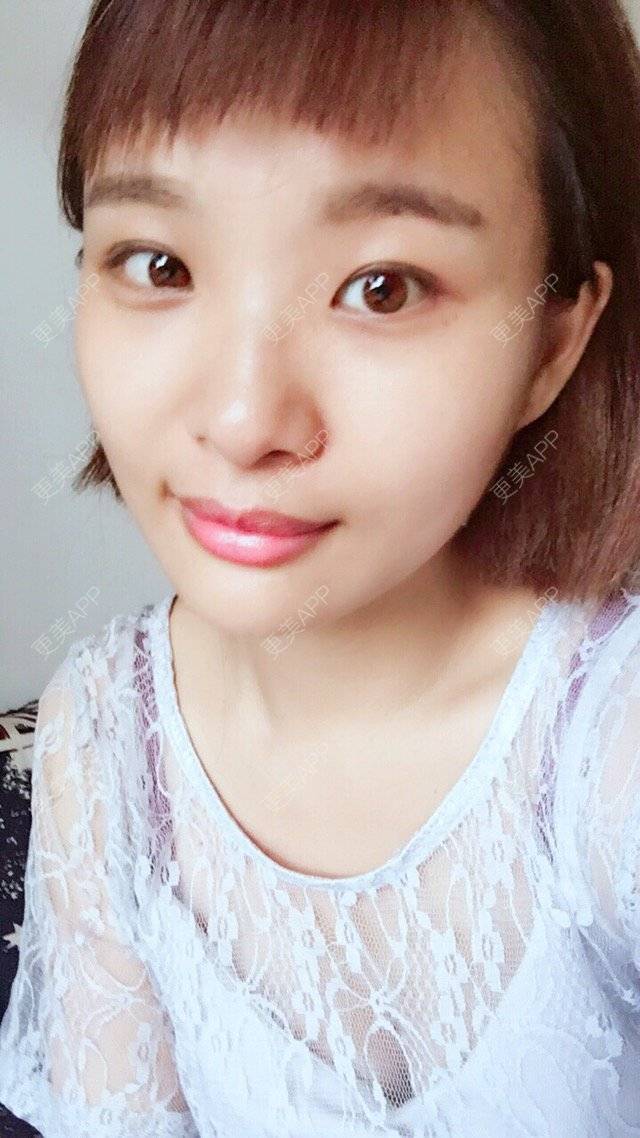 更美 - 照相机、的经验 | 注射美容 | 视频日记 | 重庆 | 自体脂肪丰全面部 | 吸脂手术