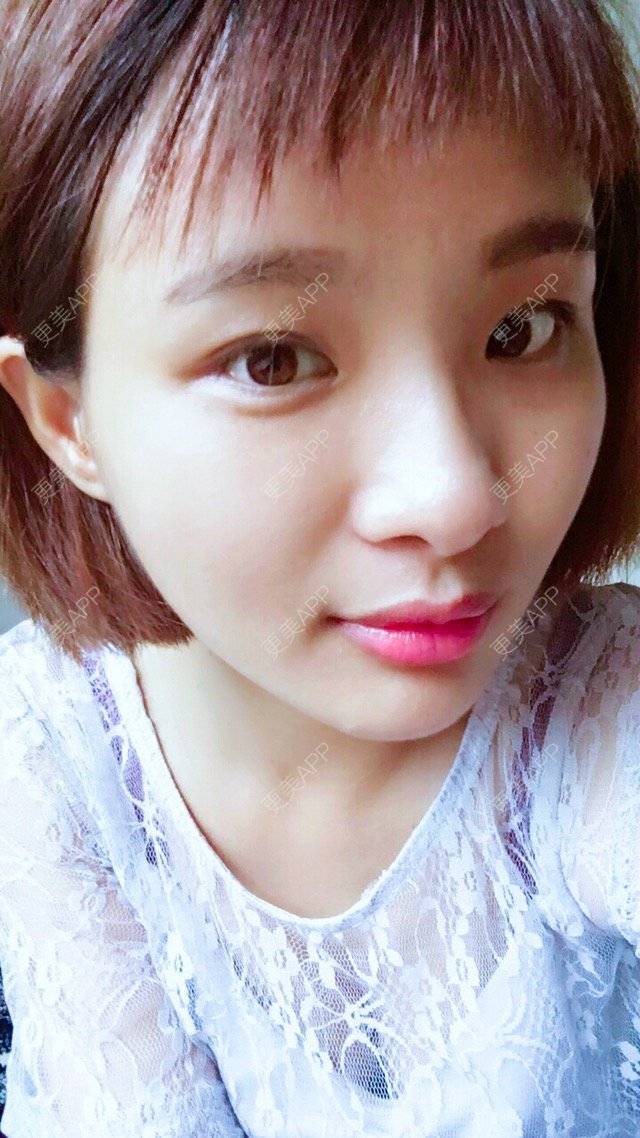 更美 - 照相机、的经验 | 注射美容 | 视频日记 | 重庆 | 自体脂肪丰全面部 | 吸脂手术