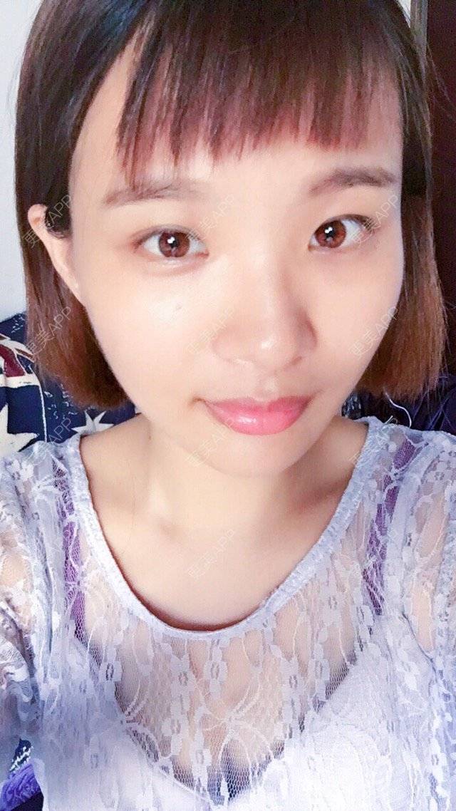 更美 - 照相机、的经验 | 注射美容 | 视频日记 | 重庆 | 自体脂肪丰全面部 | 吸脂手术
