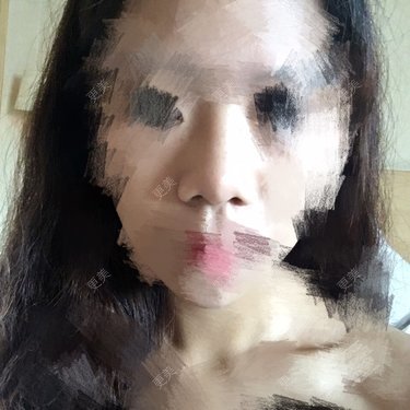 鼻部整形