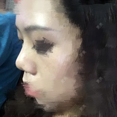 鼻部整形