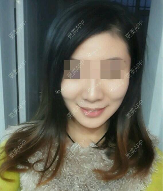 更美 - 魏洁 医生的吸脂瘦脸经验 | 脸部吸脂 | 吸脂瘦脸