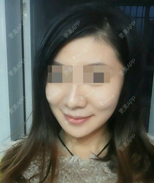 更美 - 魏洁 医生的吸脂瘦脸经验 | 脸部吸脂 | 吸脂瘦脸