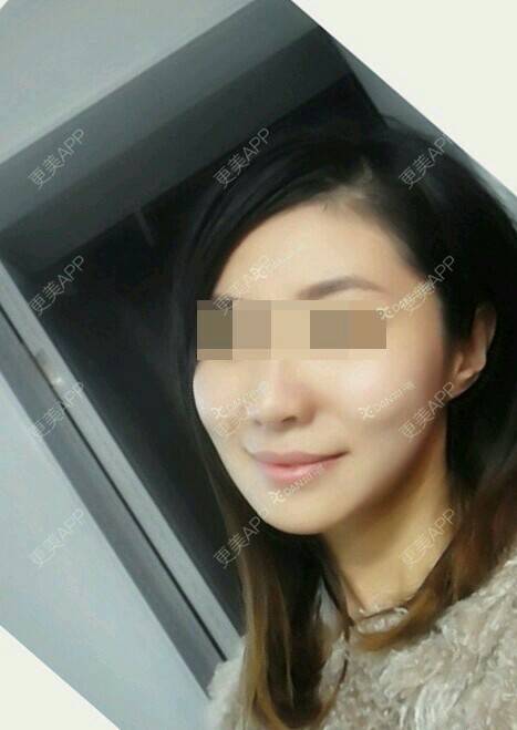 更美 - 魏洁 医生的吸脂瘦脸经验 | 脸部吸脂 | 吸脂瘦脸
