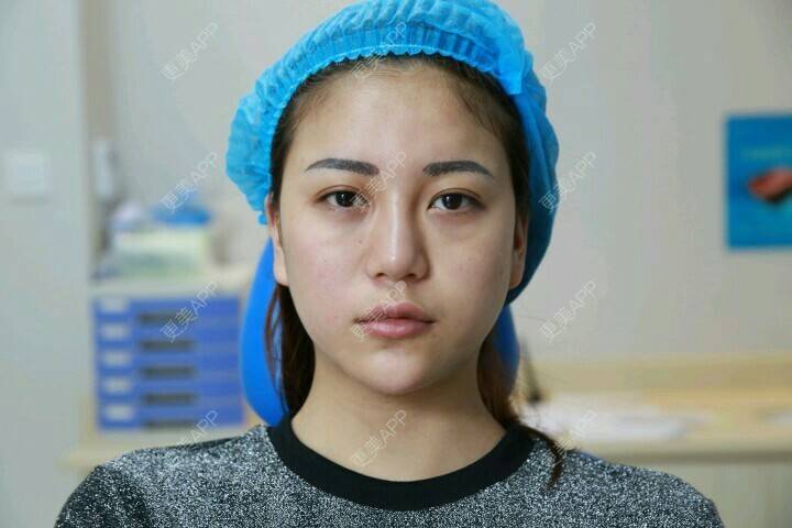 更美 - 某美美的玻尿酸经验 | 玻尿酸下巴 | 玻尿酸 | 注射玻尿酸 | 长沙