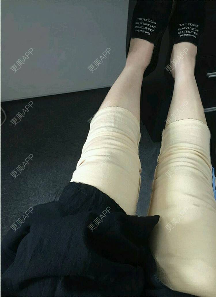 更美 - 吕婧 医生的吸脂经验 | 术后求抱抱 | 吸脂 | 吸脂瘦大腿 | 成都