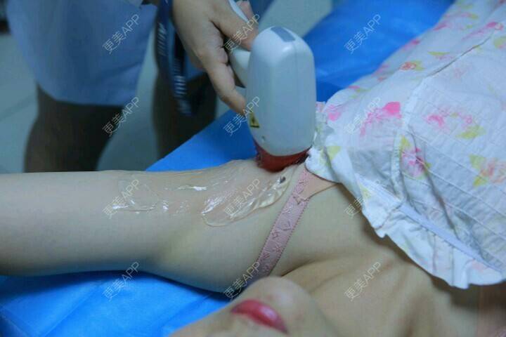 更美 - 更美用户vPu4xclMxP的激光脱腋毛经验 | 激光脱腋毛 | 口唇脱毛 | 超冰脱毛 | 南宁